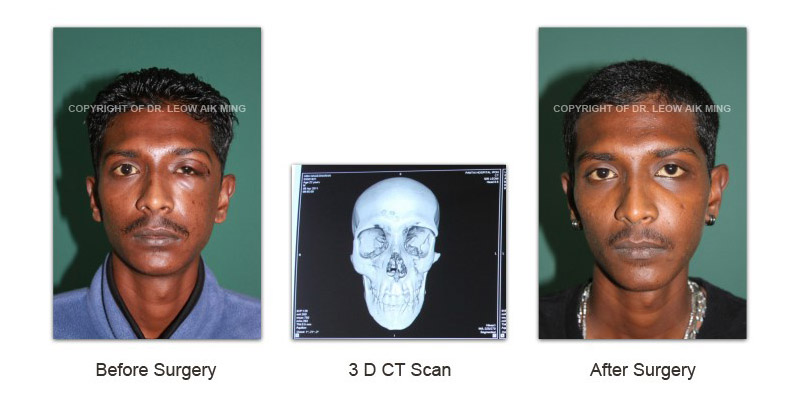 Craniofacial Trauma Reconstruction – MSPRS