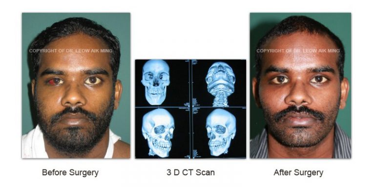 Craniofacial Trauma Reconstruction – MSPRS