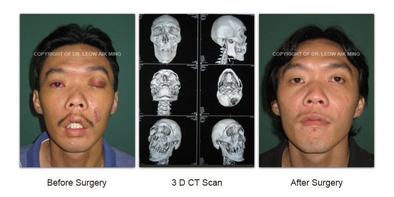 Craniofacial Trauma Reconstruction – MSPRS