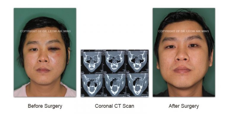 Craniofacial Trauma Reconstruction – MSPRS