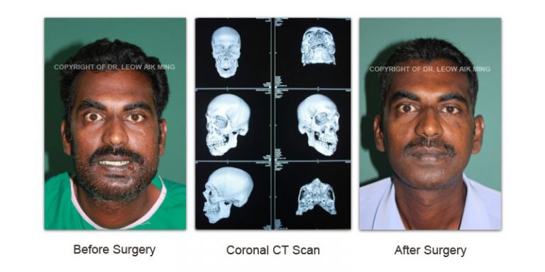 Craniofacial Trauma Reconstruction – MSPRS