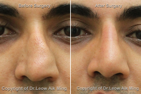 Septorhinoplasty – Msprs