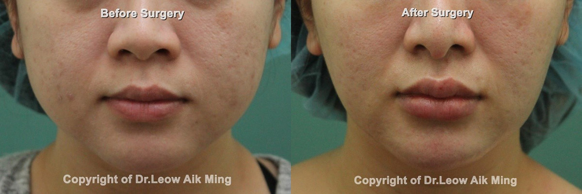 Buccal Fat Removal – MSPRS